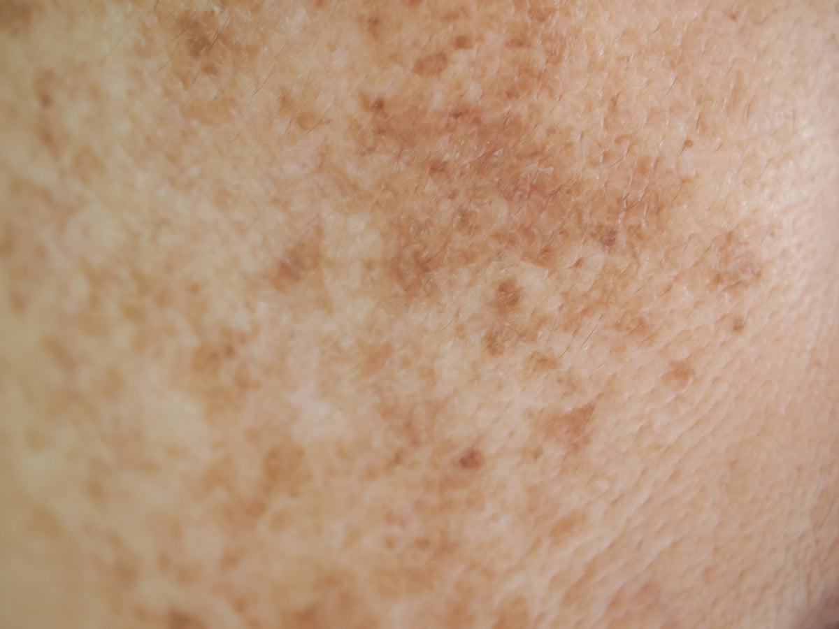 Dark Spots & Hyper-Pigmentation