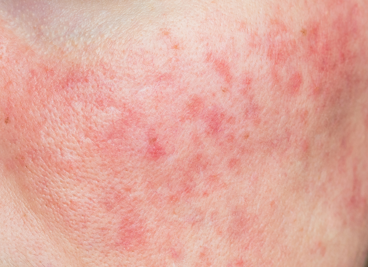 Rosacea & Redness